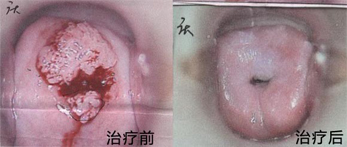 宫颈治疗前后对比图