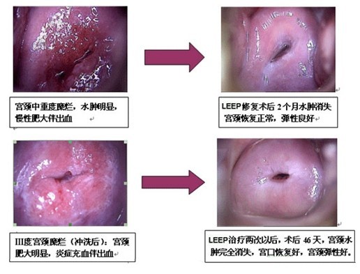 LEEP治疗宫颈糜烂